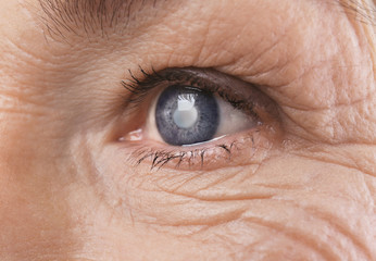 Elderly Vision Problems II – Glaucoma Diet and Exercise, Vitamins, Prevention and Glaucoma Treatments